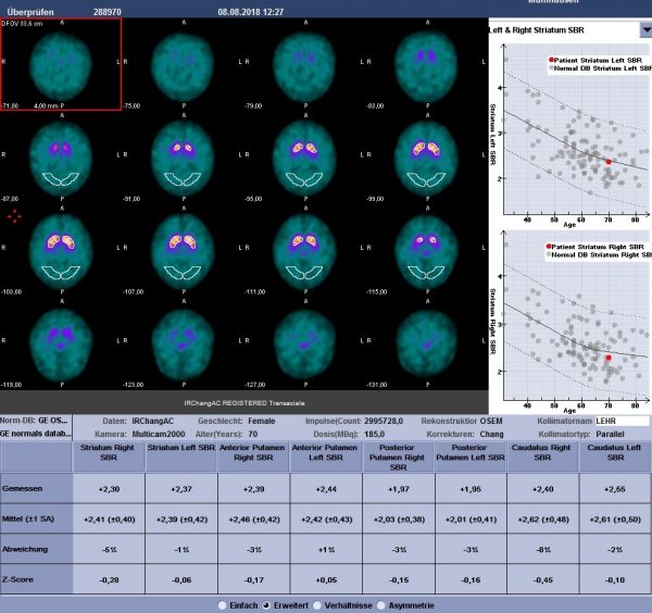 Nuklearmedizinische Untersuchung – Szintigraphie – Radiologisches ...